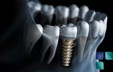 Implante Dentário em Curitiba