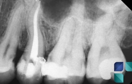 Tratamento de Canal e Endodontia em Curitiba