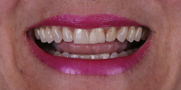 lente-de-contato-dental-mass-odontologia01