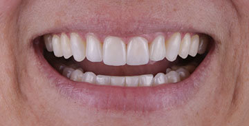 lente-de-contato-dental-mass-odontologia02