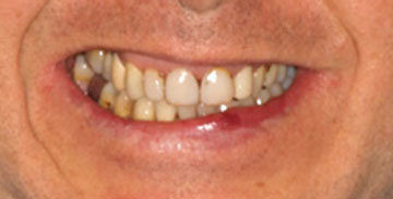 lente-de-contato-dental-mass-odontologia03