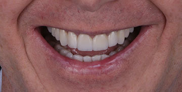 lente-de-contato-dental-mass-odontologia04