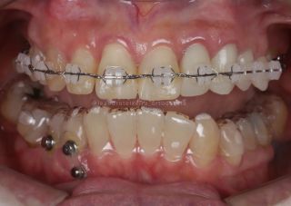 Invisalign ou aparelho comum - Ortodontia em Passo Fundo ortopedia